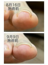 キャンディベース フクシマ(Candybase Fukushima)/密かに人気の巻き爪メニュー！