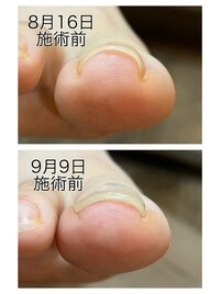 密かに人気の巻き爪メニュー！