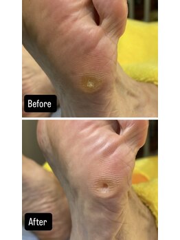 ドクターネイル爪革命 所沢西店/たこ魚の目［所沢／狭山ヶ丘］