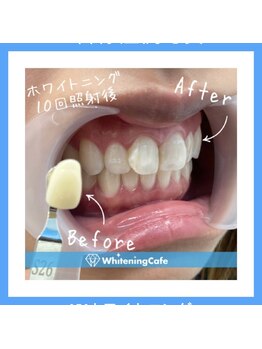 ホワイトニングカフェ 和歌山ガーデンパーク店(WhiteningCafe)/10回照射症例