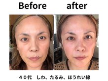 ギンザ リボーン(Ginza Reborn)/しわ、たるみ、ほうれい線