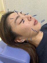 まえかわ鍼灸整骨院/美容鍼