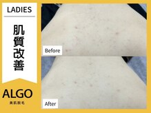 アルゴ 敦賀店(ALGO)/脱毛だけじゃない！
