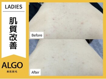 アルゴ 敦賀店(ALGO)/脱毛だけじゃない！