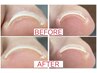 【1本】フット巻き爪改善コース●レジスタンスプレート　