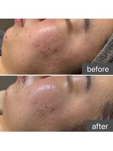 ロッタ エクリュ(Lotta ecru+)/REVI剥けないハーブピーリング