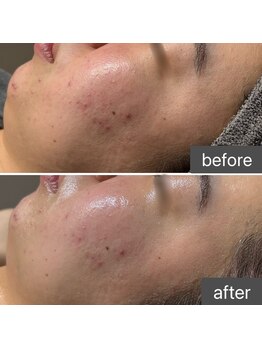 ロッタ エクリュ(Lotta ecru+)/REVI剥けないハーブピーリング