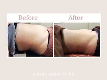 トータルビューティー ゆみえエステ(Total Beauty)/痩身/マグシェイプ　ウエスト