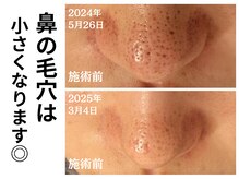 エリン(ERIN)の雰囲気（もう毛穴で悩まない◎根本改善してノーファンデ美肌に♪〔毛穴〕）