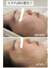 エスプラス エヌプラス(S+/N+)/フェイシャルエステ　ビフォアフ