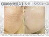 【無針水光注入】シミ・エイジングケアコース