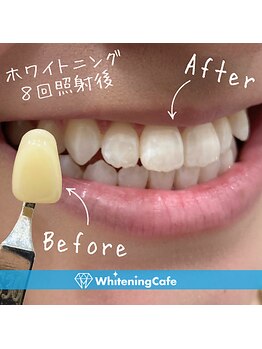 ホワイトニングカフェ 茨木店/8回照射