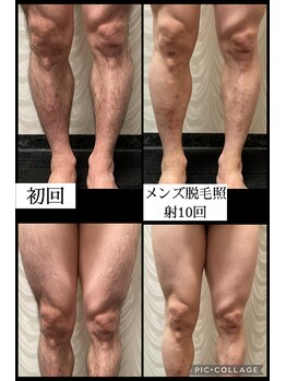 ナムズ(Nams)/全身脱毛（顔VIO込み)