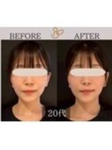 チョコバリ 中目黒店(chocobari)/小顔×リフトアップ(美容鍼)20代