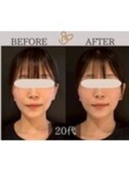 チョコバリ 中目黒店(chocobari)/小顔×リフトアップ(美容鍼)20代