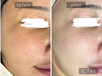 アムールサロン(Amour salon)/光フェイシャルでシミケア/新宿