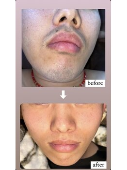 オーシャンズ 谷町四丁目店(OCEANS)/鬚脱毛施術症例