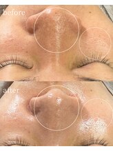 サロンナナジュウニ(Salon72)/毛穴/ニキビ