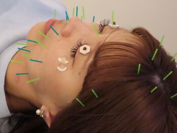 ビゴー鍼灸院 円山院(bigo鍼灸院)/たるみ改善・むくみスッキリ!