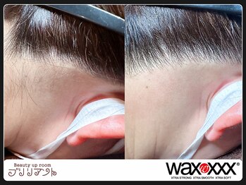 ブリリアント/うなじのwax脱毛