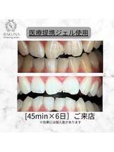 ラクナ ホワイトニング(RAKUNA)/歯科医提携ホワイトニング症例