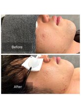 脱毛サロン メンズ 堂々/脱毛ビフォーアフター