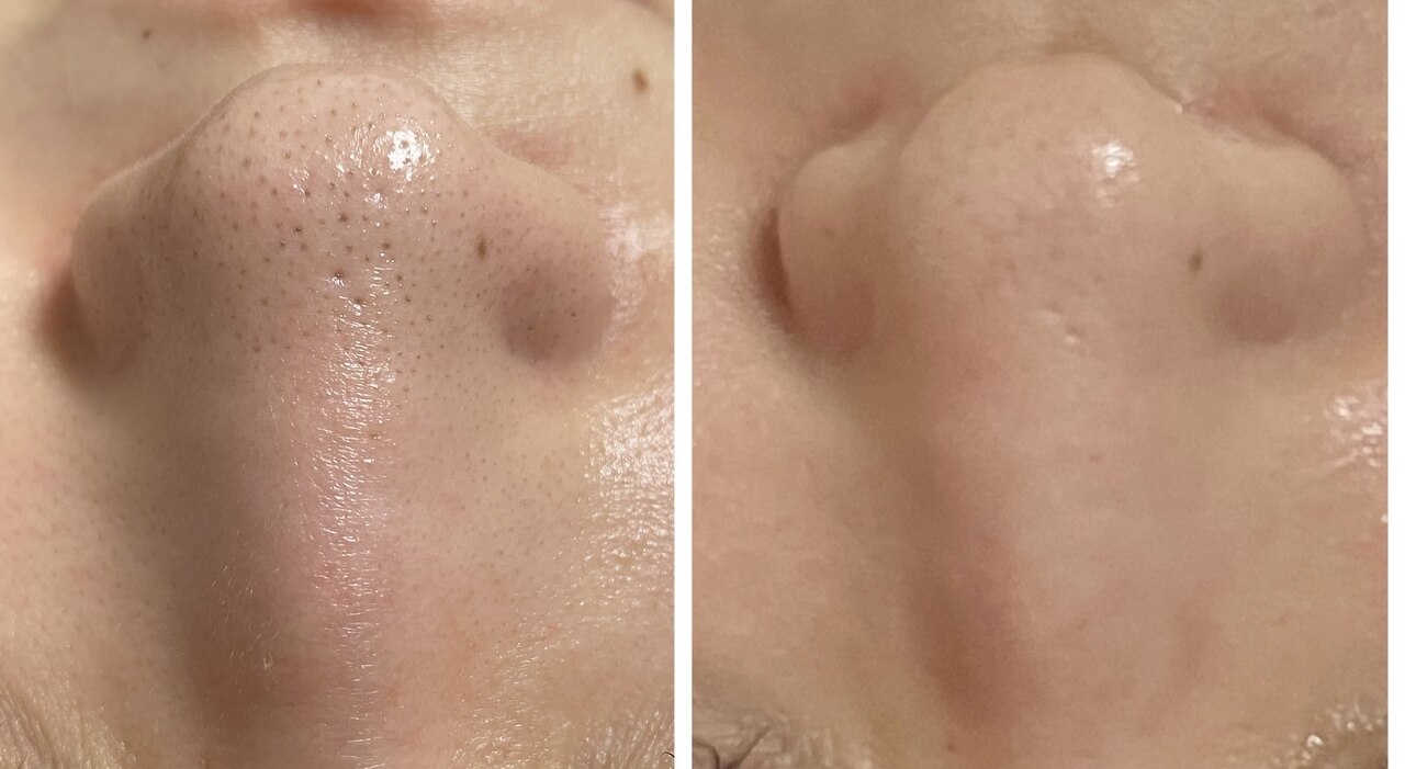 苫小牧市で毛穴洗浄・毛穴吸引が人気のエステサロン｜ホットペッパー