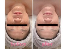 サロン アイリス(salon iRiS)/フェイシャルエステで透明感UP♪