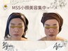 【小顔矯正】MSS小顔美容集中ケア　体験クーポン