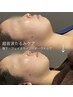 ＜リフトアップ×小顔＞超音波たるみケア