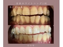 白の雫/美容ホワイトニング1回
