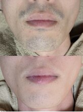 ドルチェ(Dolce)/ヒゲ脱毛《before after》