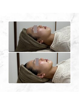 サラン(SALON)/お顔 ビフォー アフター