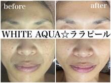 ホワイトアクア 天王寺本店(WHITE AQUA)/ララピールでたまご肌が叶う！