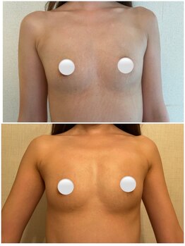 ラディス(Radice.)/【バストアップ症例】☆