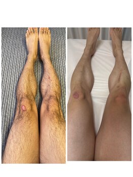 リレア(RELAIR)/【　あし脱毛　】