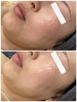 イル 名取店(iru)/糸式リフトアップフェイシャル