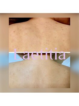 レティティア(Laetitia)/背中ハーブ脱毛ハイドロジェリー