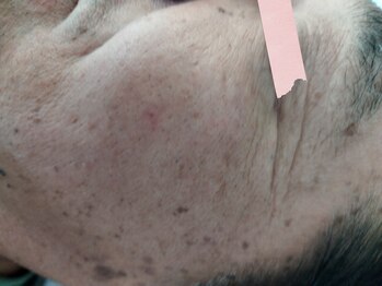 麻謝/純正レチノールピール　Before