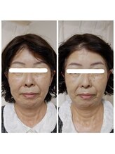 アンティクイーン(Antiqueen)/たるみ改善　引き上げ