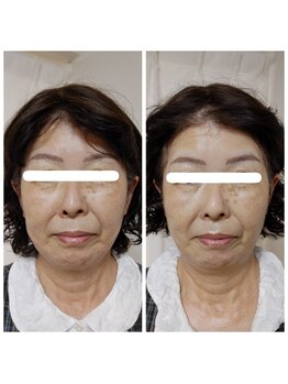 アンティクイーン(Antiqueen)/たるみ改善 引き上げ