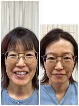 ひだまり鍼灸院/美容鍼before → after