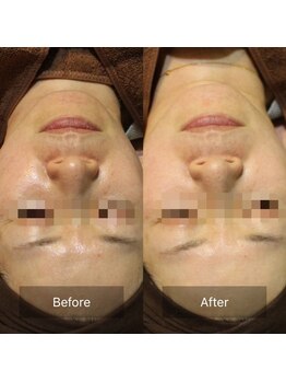 ミヨン(Miyong)/ラティニックス/くすみ・美白