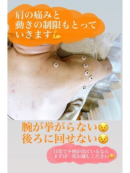 あんどら鍼灸接骨院/肩が挙がらない