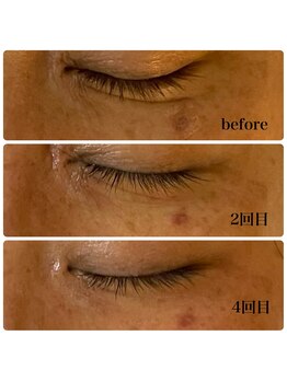 ルマエクレ(rmaecla)/深いシワ