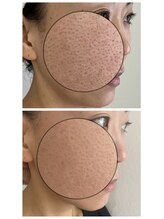 オシュン 北九州(Oshun)/毛穴改善☆ドライピーリング