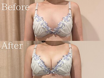 ナリッシュ バスト 六本木(Nouriche Bust)/バストアップ◇ビフォーアフター