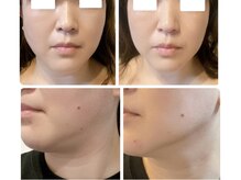 ♯二重あご　♯たるみ　♯毛穴　♯小顔　♯フェイシャル