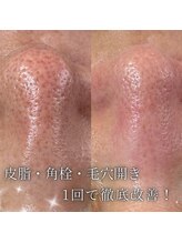 ラトワ(LATOWA)/肌質改善ピール＋毛穴エクスト