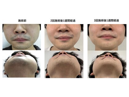つくば市のメンズ脱毛が人気のエステサロン 口コミ人気ランキング ホットペッパービューティー